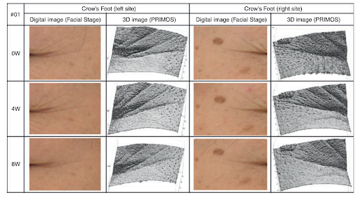 Accelerating new nail growth