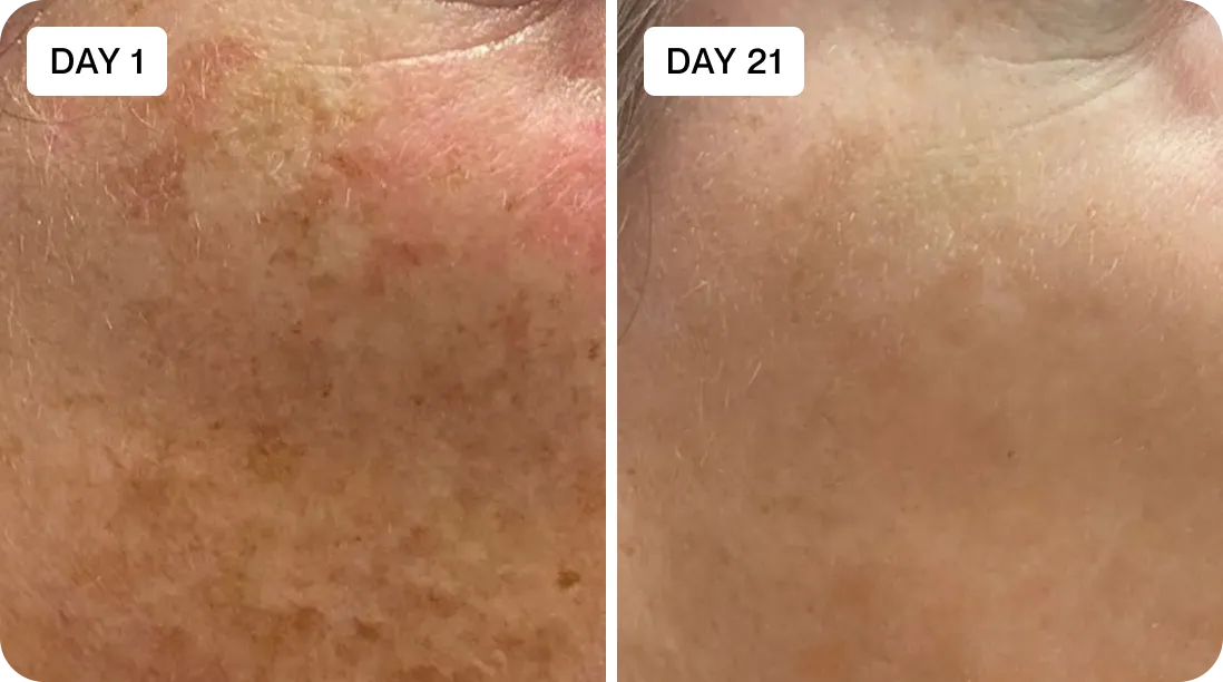 Sophia before and after results
