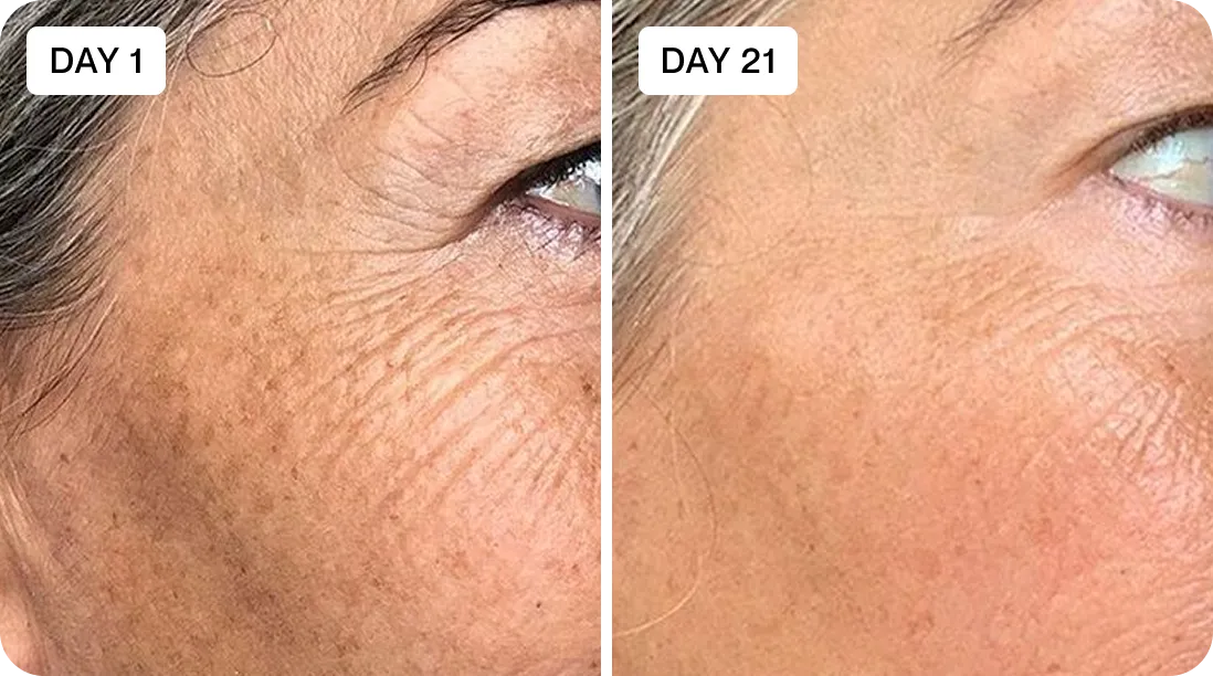 Elisabeth before and after results