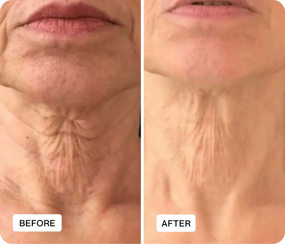 Before and after result 5