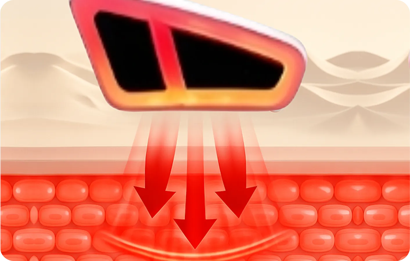Renewa EyeLift technology illustration