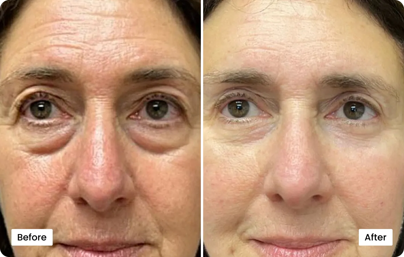 Renewa EyeLift before and after