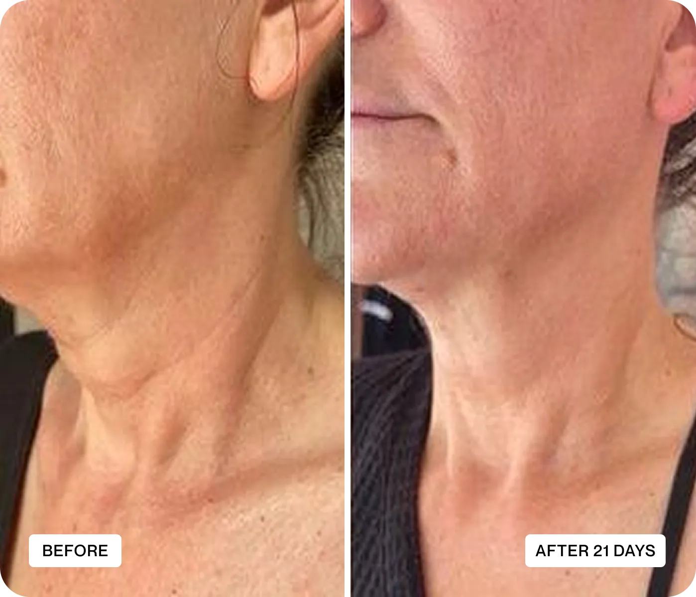 Resultado del cuello antes y después