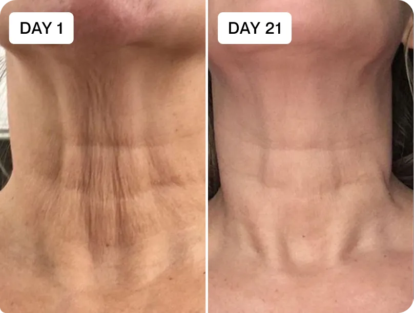 RenewaLift neck before and after result