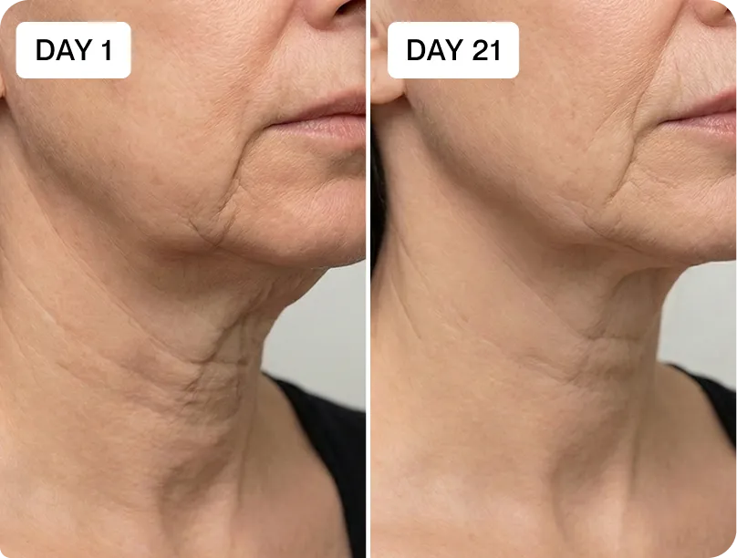 RenewaLift jawline before and after result