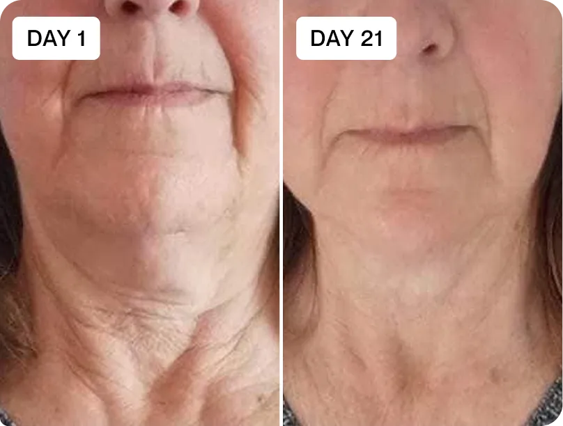 RenewaLift neck tightening before and after result
