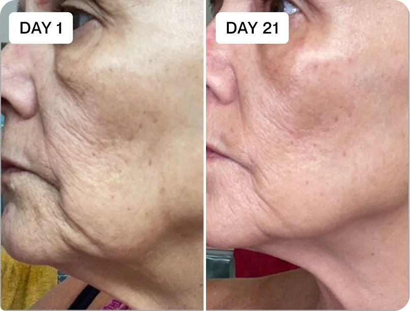 RenewaLift face and jawline before and after result