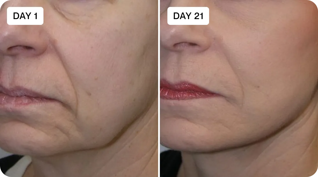 Karla before and after result