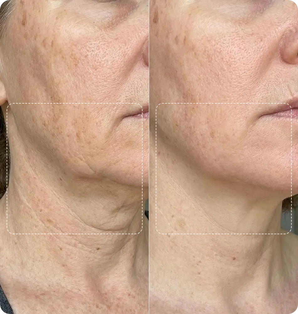 Before and after results around the mouth and jawline