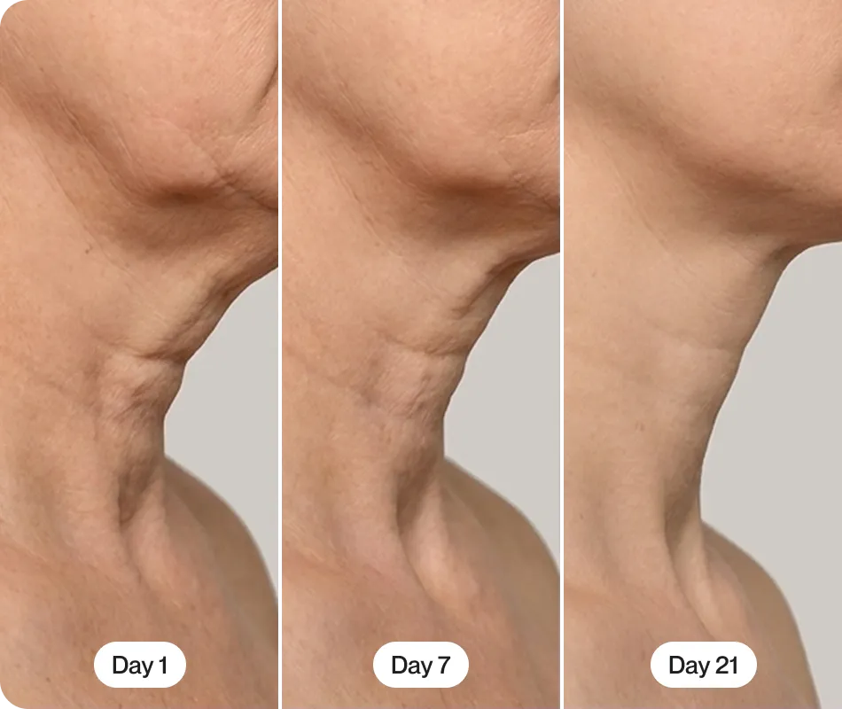 Clinic red light treatment compared with RenewaLift