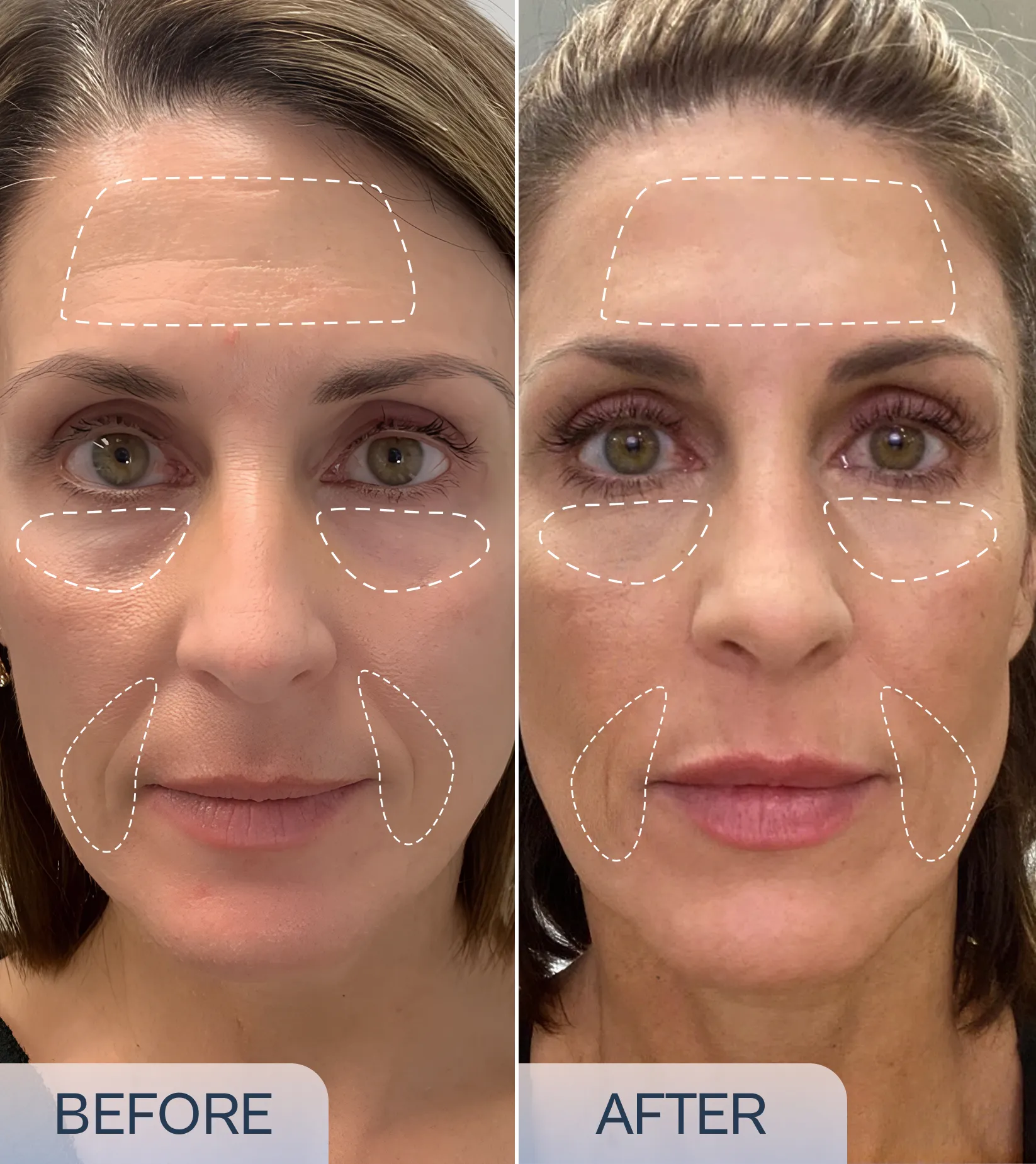Micro-Infusion Precision Patches product image 5