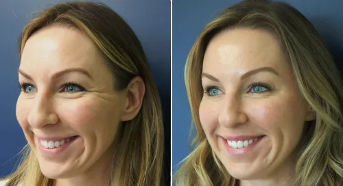 Good-Bye Concealer!