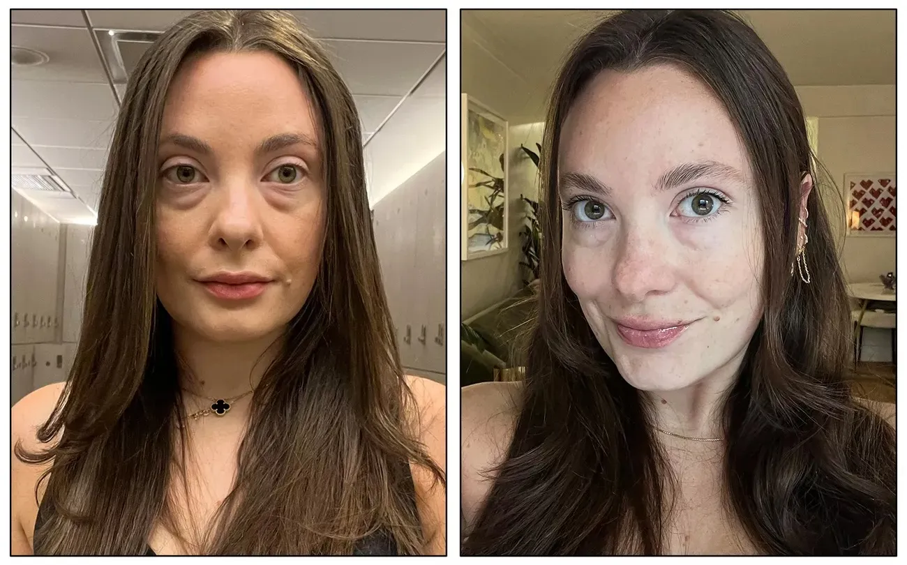 Fresh Eyes, No Needles