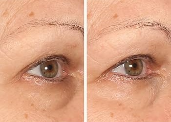 before after