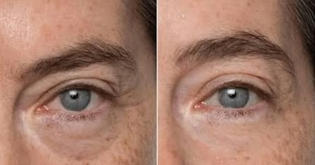before after