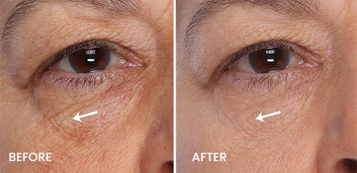 eye results