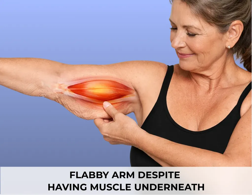 Flabby arm despite having muscle underneath