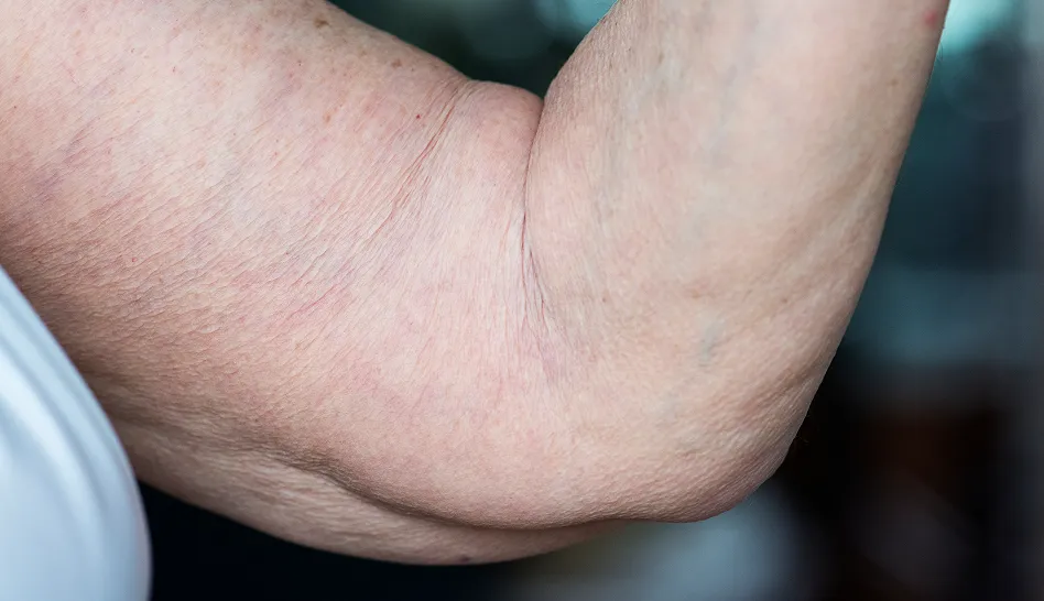 Fats, Protein, Sugars, Carbs - Flabby Arms