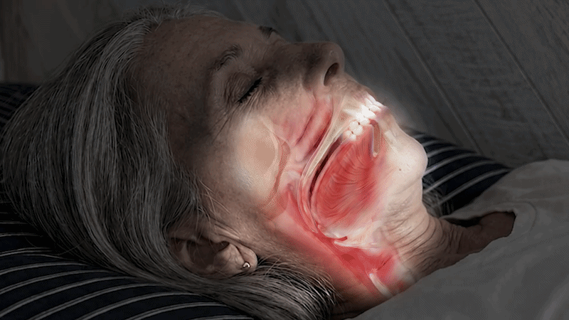 A mandibular advancement device