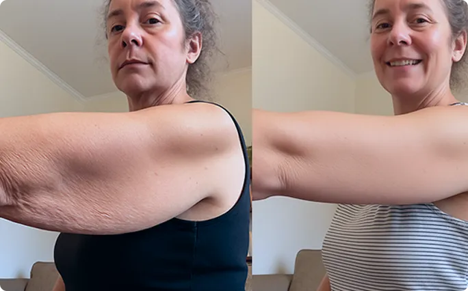 Customer using MyoGlow device