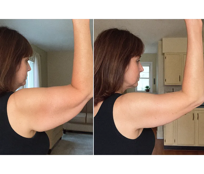 Customer using MyoGlow device