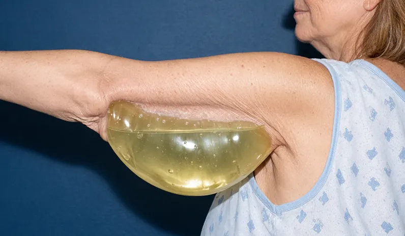 Lymphatic fluid diagram