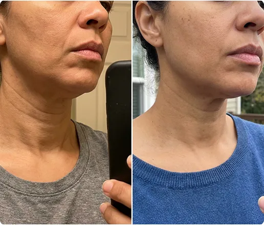 Customer using MyoGlow device