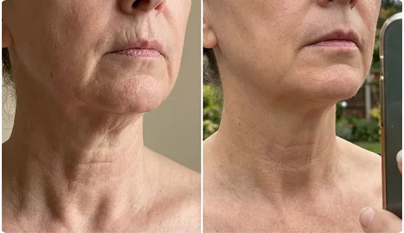 Customer using MyoGlow device