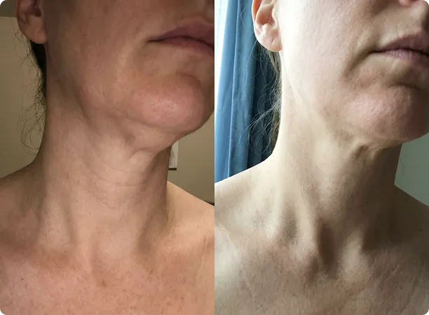 Customer using MyoGlow device