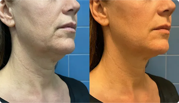 Customer using MyoGlow device