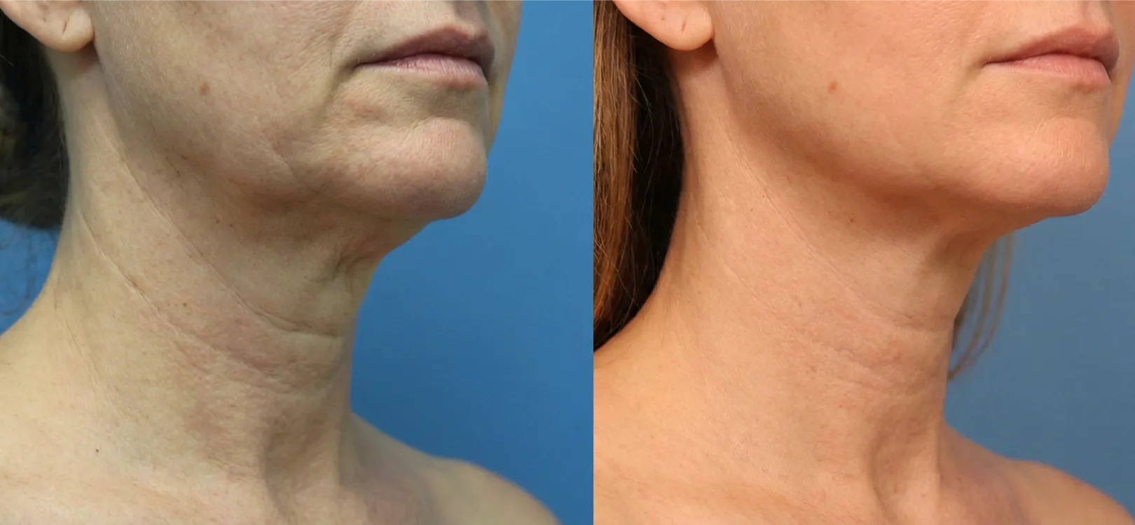 Arm Toning Solutions