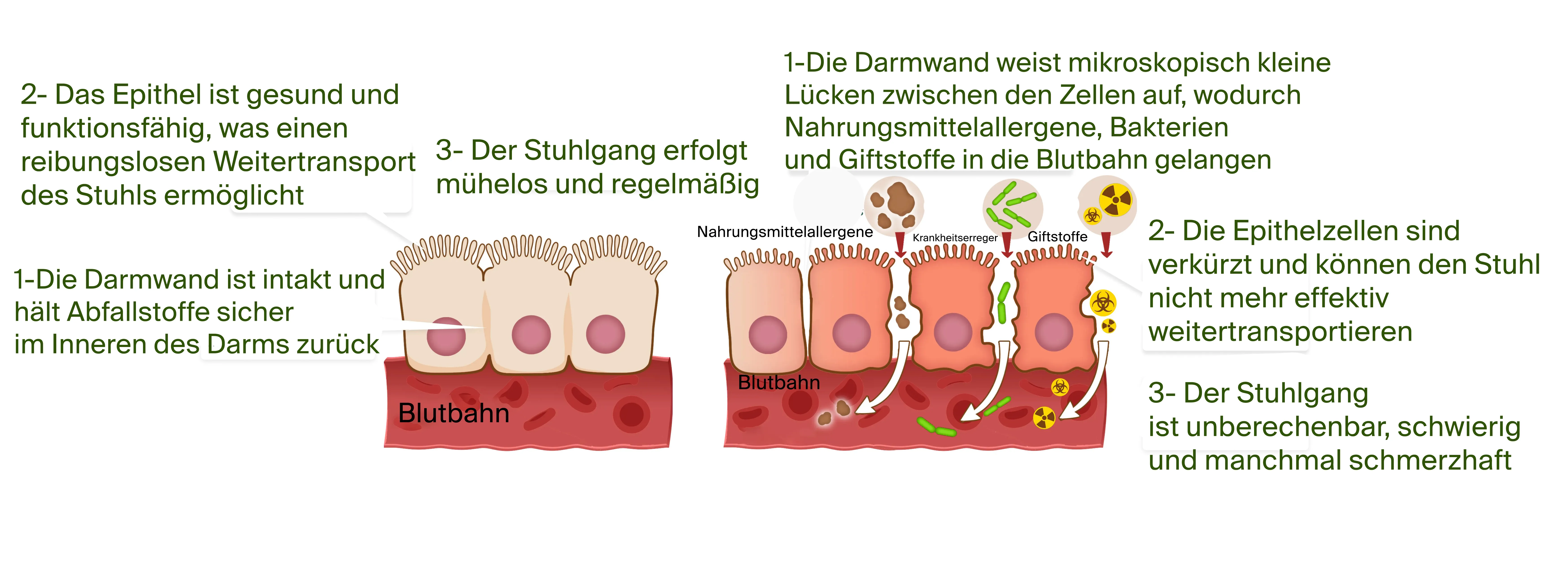 Healthy vs Leaky Gut Diagram