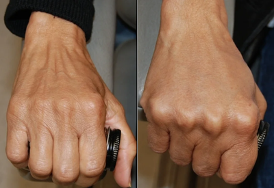 Woman with hair loss