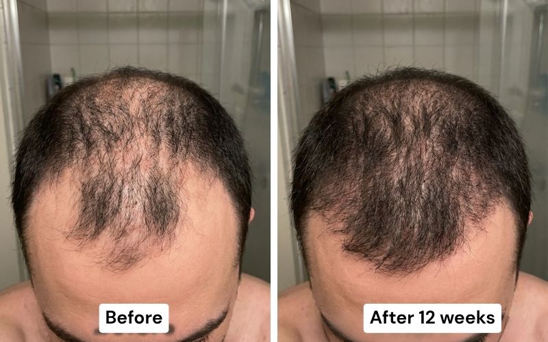 Before and after: receding temples to filled in