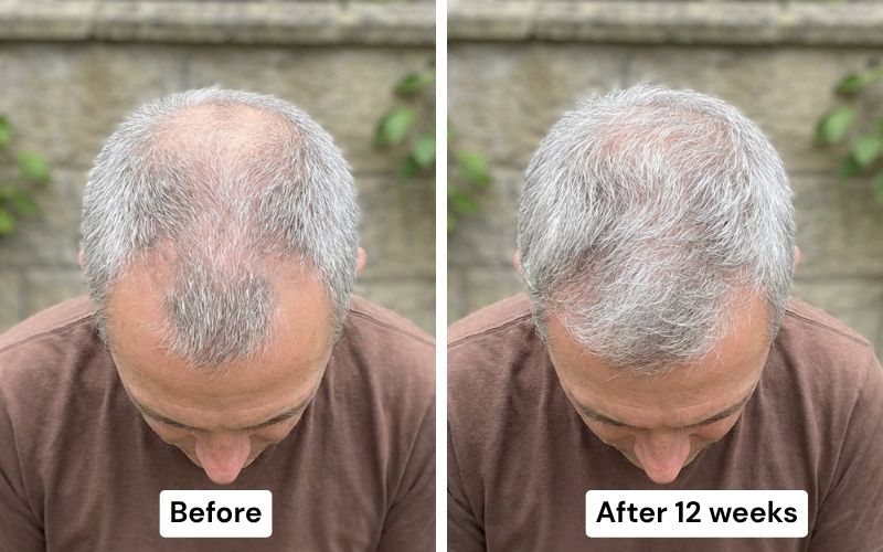 Before and after: frontal recession to restored hairline