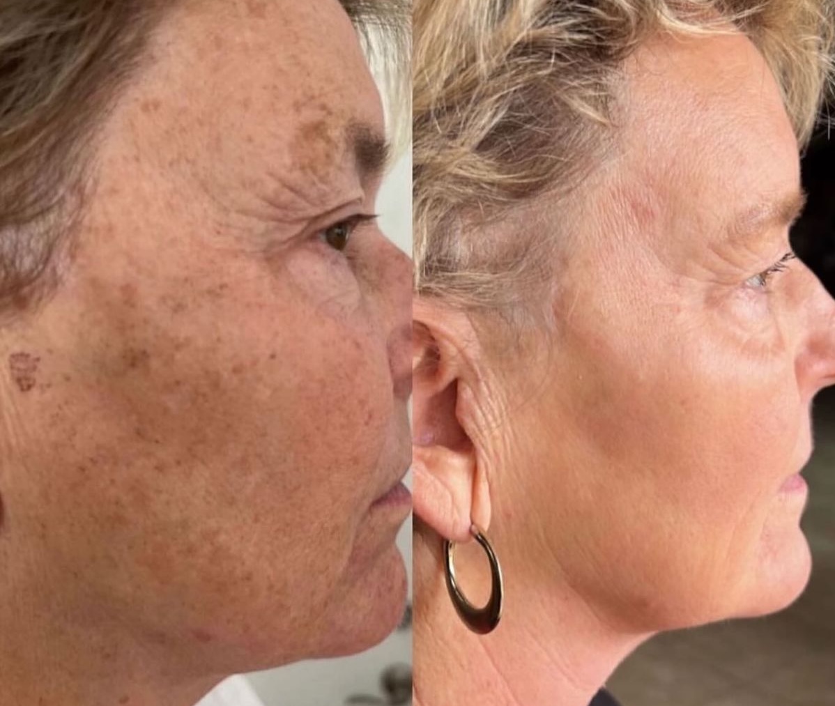 Micro Infusion Device Being Used