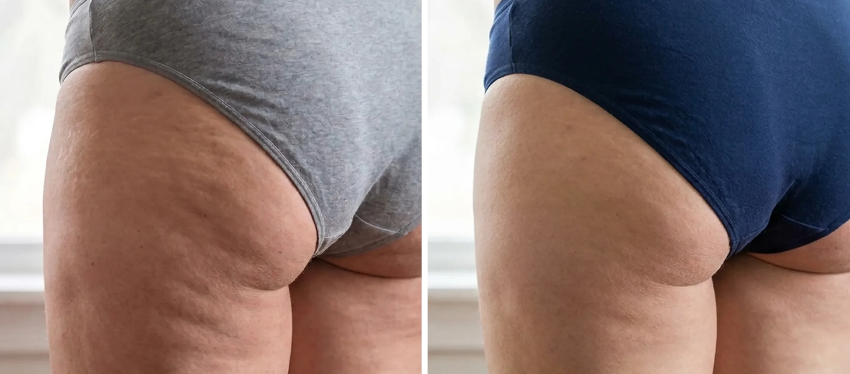 Before and after results with needle-free filler device