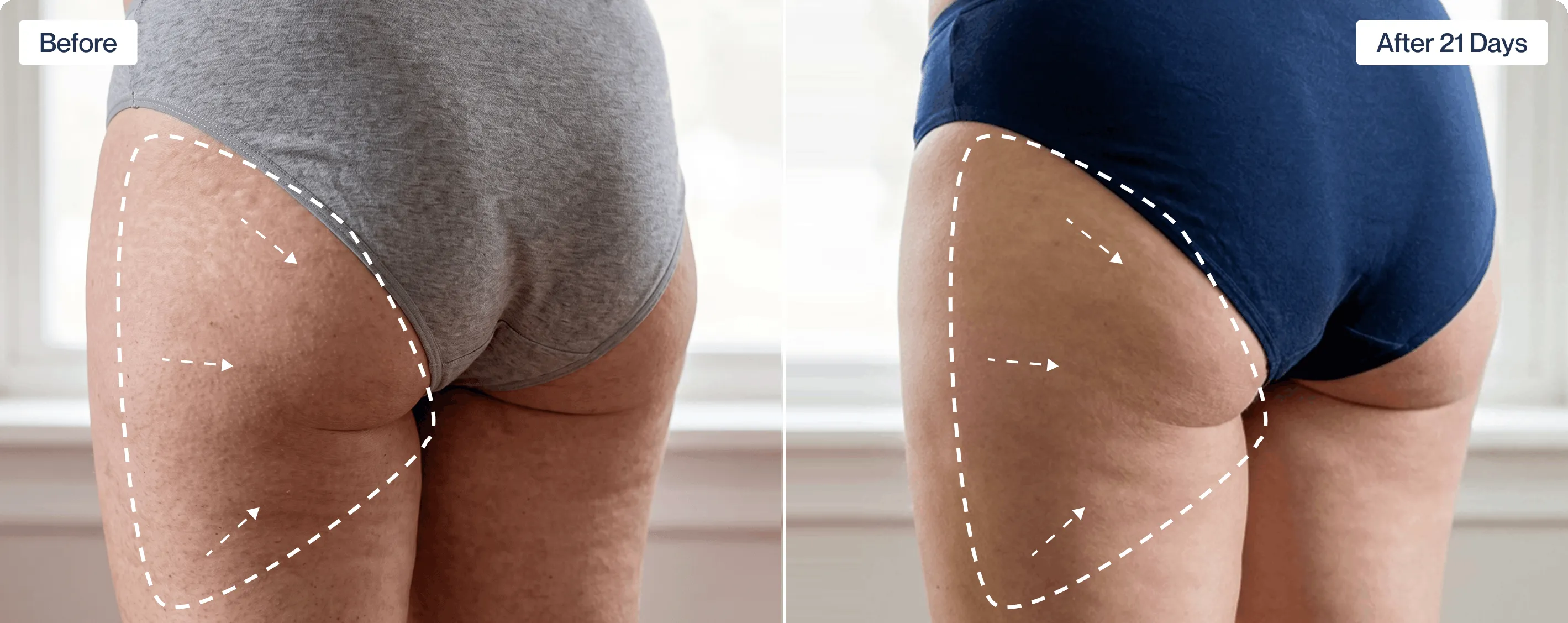 Before and after results with needle-free filler device