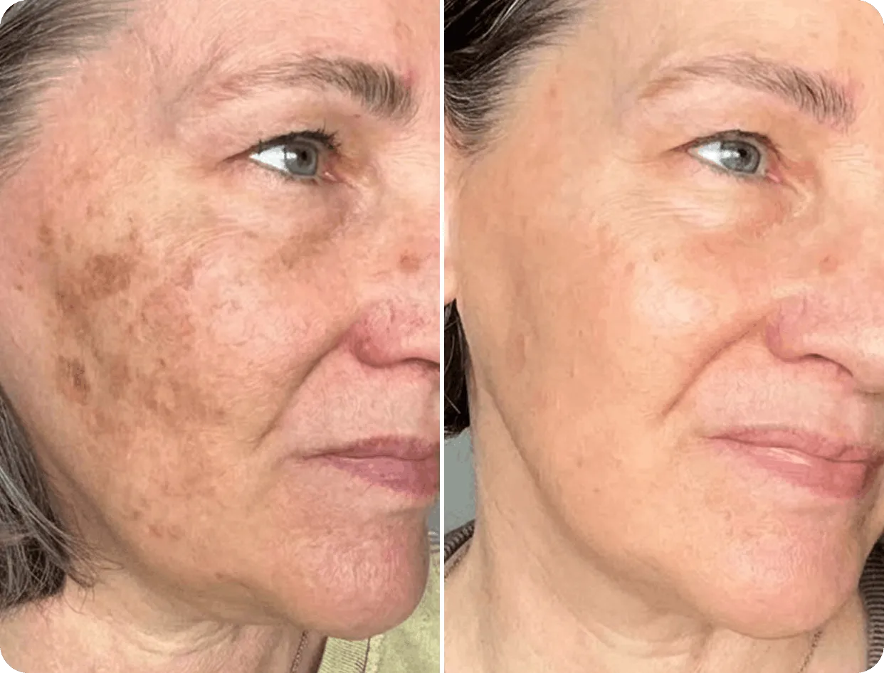 Before and after skin improvement