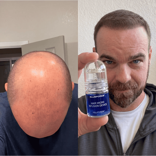 Marcus before and after