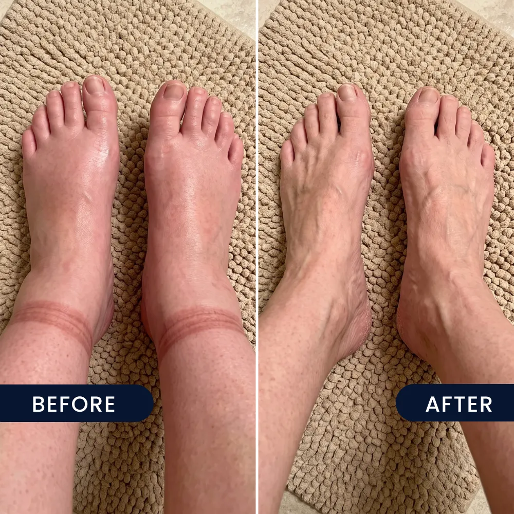 Swollen feet and ankles, before and after