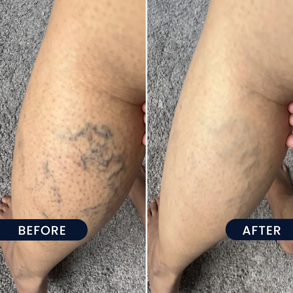 Varicose and spider veins, before and after