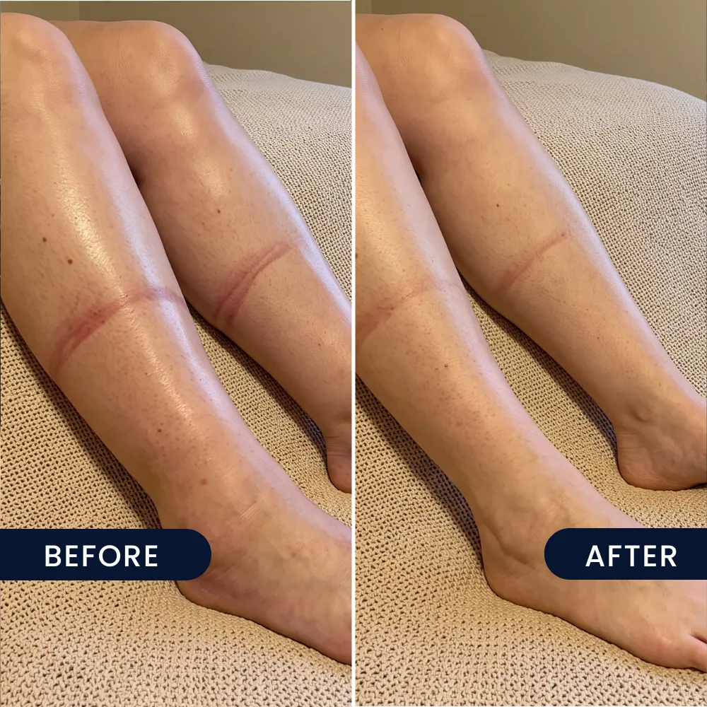 Heavy, tired legs, before and after