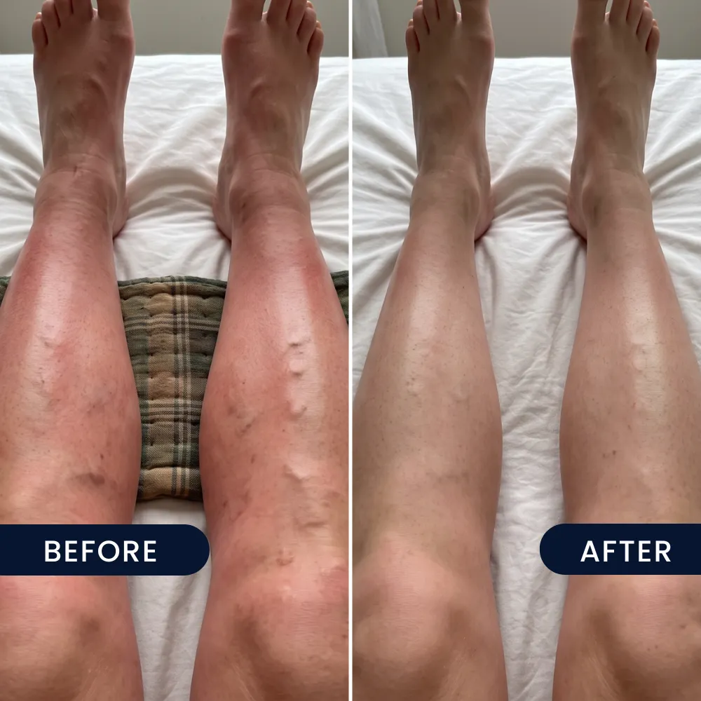 Painful, aching legs, before and after