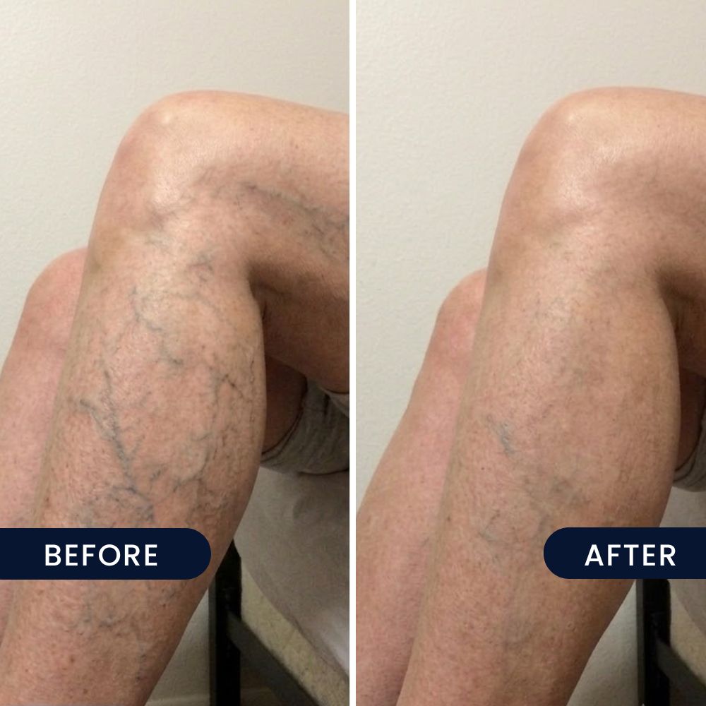 Crepey Arms before and after