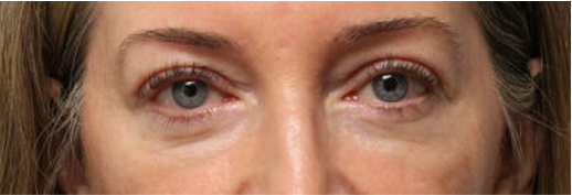 Eye bags