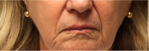 Lips lines & sagging corners