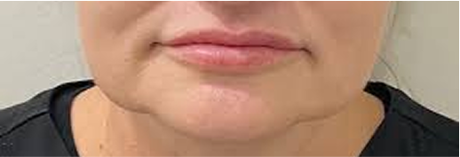 Saggy jowls