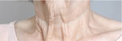 Deep neck creases