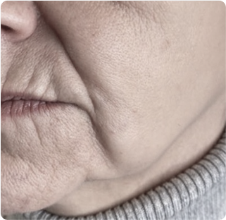 Jowls